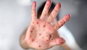 Kadiskes Riau : Virus Mpox Belum Terdeteksi di Riau, Warga Diminta Tetap Waspada